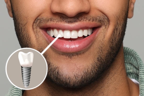 Ceramic Dental Implants: The Metal-Free Way to Restore Your Smile