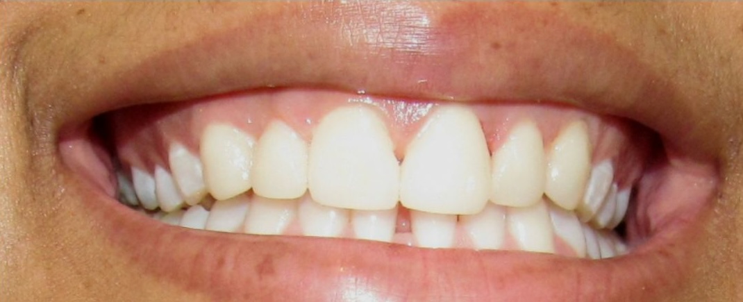 Teeth whitening after