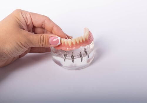 Denturse vs Implants