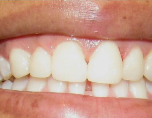 Teeth whitening after