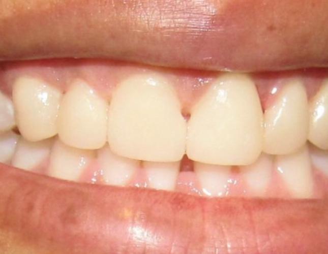 Teeth whitening before